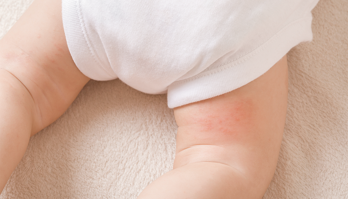 [라이프케어] 아이가 베이지색 러그 위에 엎드려 있고 아이의 양쪽 허벅지에 아토피로 보이는 발진이 있습니다.